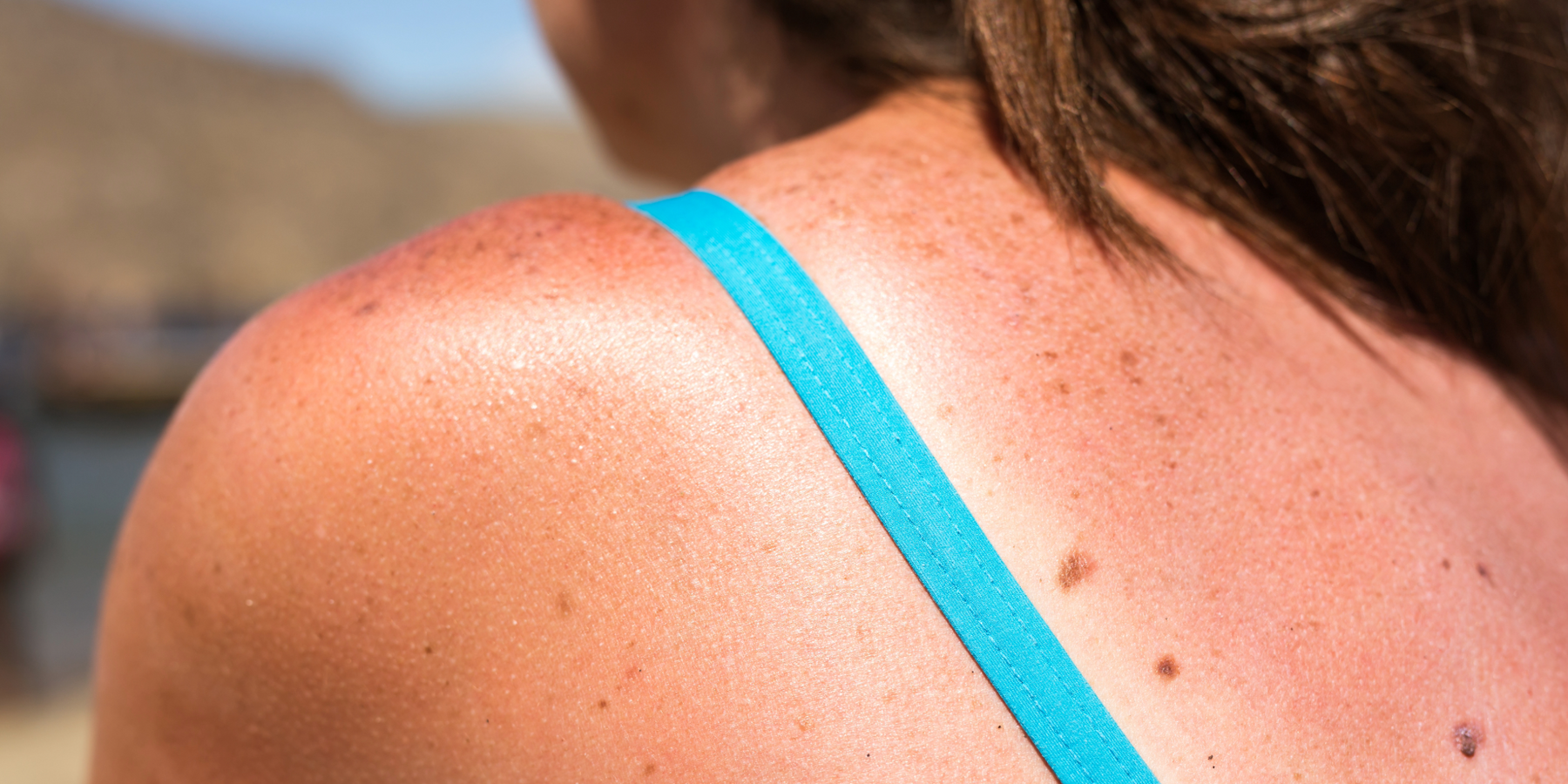 close up of woman in bathing suit's shoulder, showing sun damage, sunburn, and freckles